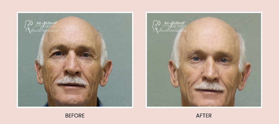 BeforeAfterTemplate-BrowLift2.jpg