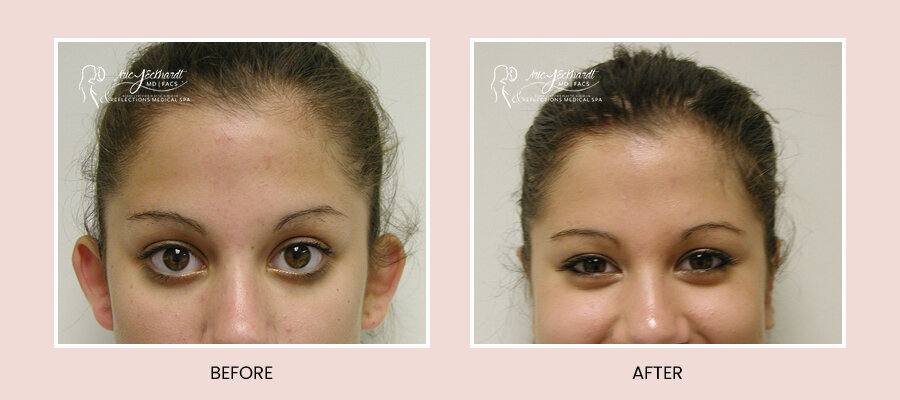 BeforeAfterTemplate-Otoplasty.jpg