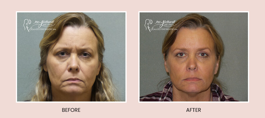 BeforeAfterTemplate-InjectablesJuvederm.jpg