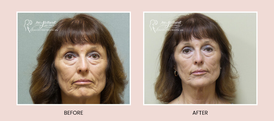 BeforeAfterTemplate-InjectablesJuvederm2.jpg