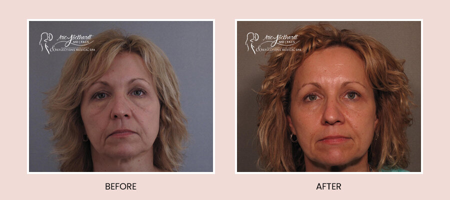 BeforeAfterTemplate-InjectablesJuvederm3.jpg