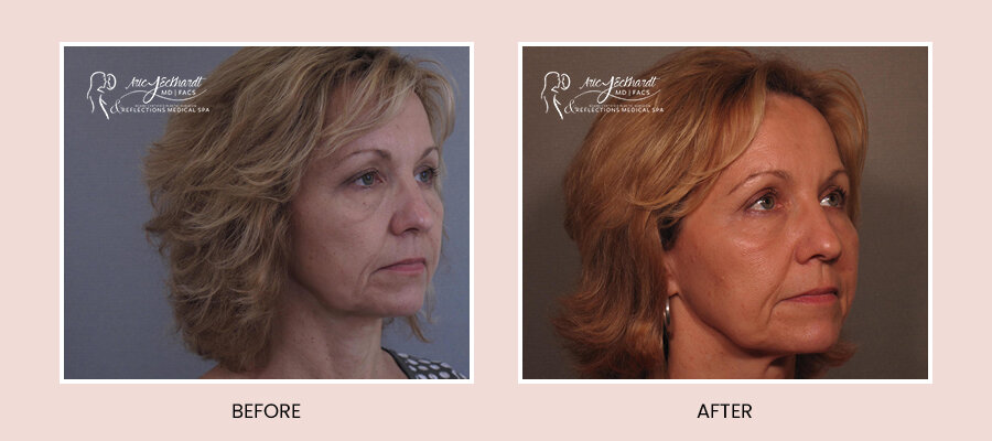 BeforeAfterTemplate-InjectablesJuvederm4.jpg