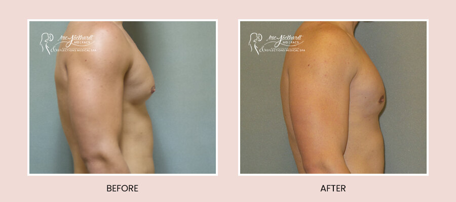 BeforeAfterTemplate-Gynecomastia2.jpg