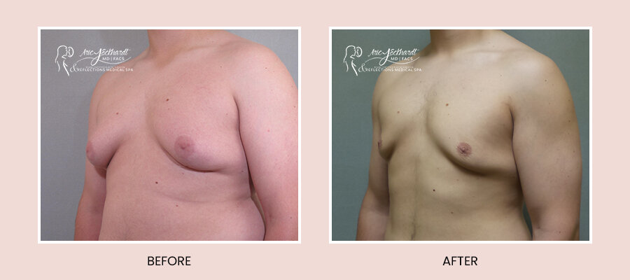 BeforeAfterTemplate-Gynecomastia.jpg