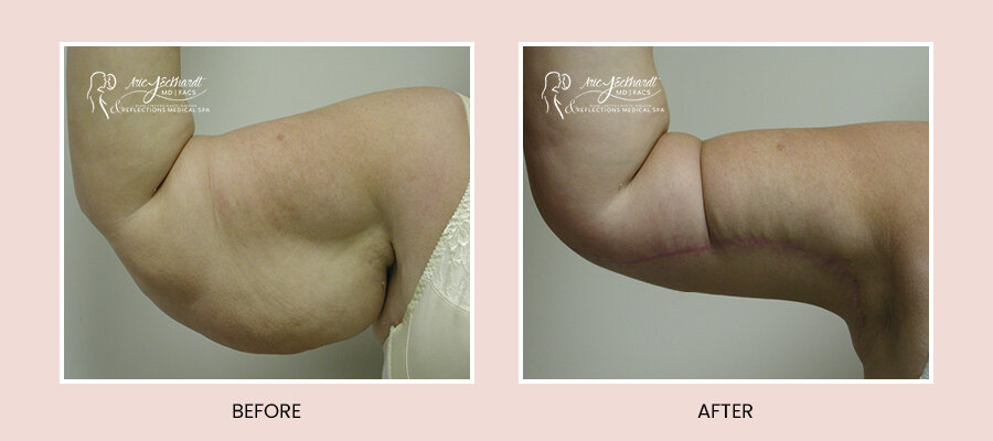 BeforeAfterTemplate-ArmLift.jpg