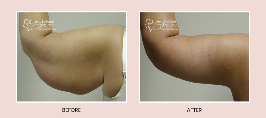 BeforeAfterTemplate-ArmLift2.jpg