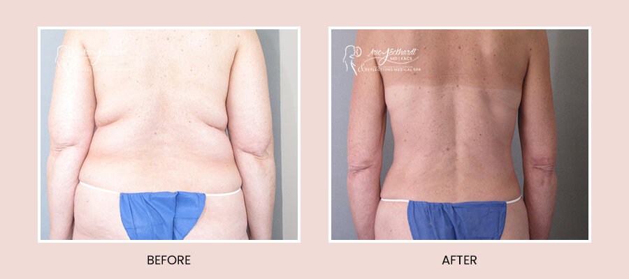 BeforeAfterTemplate-Liposuction2.jpg