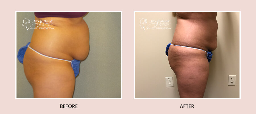 BeforeAfterTemplate-Liposuction3.jpg