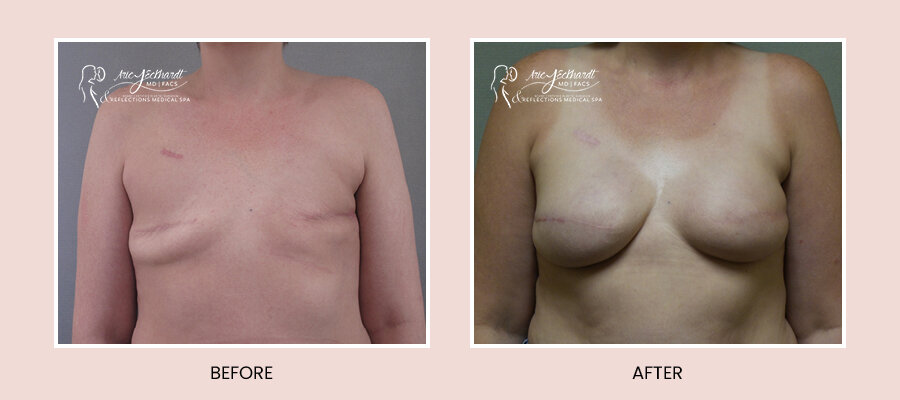 BeforeAfterTemplate-BreastReconstruction.jpg