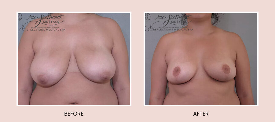 BeforeAfterTemplate-BreastReduction4.jpg