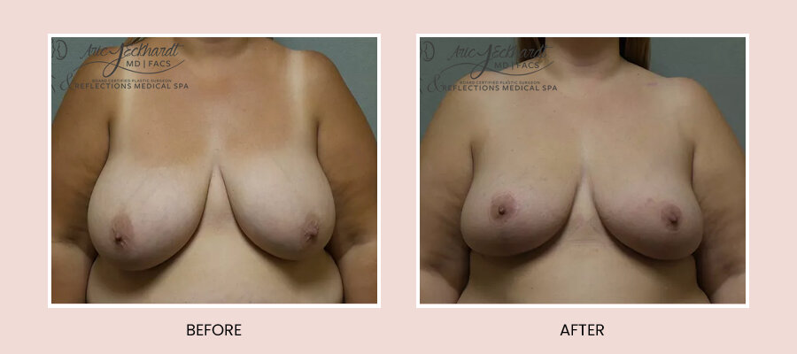 BeforeAfterTemplate-BreastReduction3.jpg