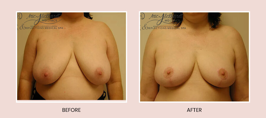 BeforeAfterTemplate-BreastReduction2.jpg