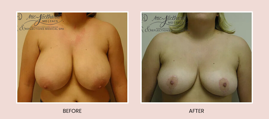BeforeAfterTemplate-BreastReduction.jpg
