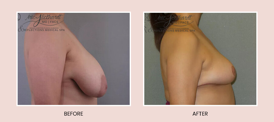 BeforeAfterTemplate-BreastReduction5.jpg