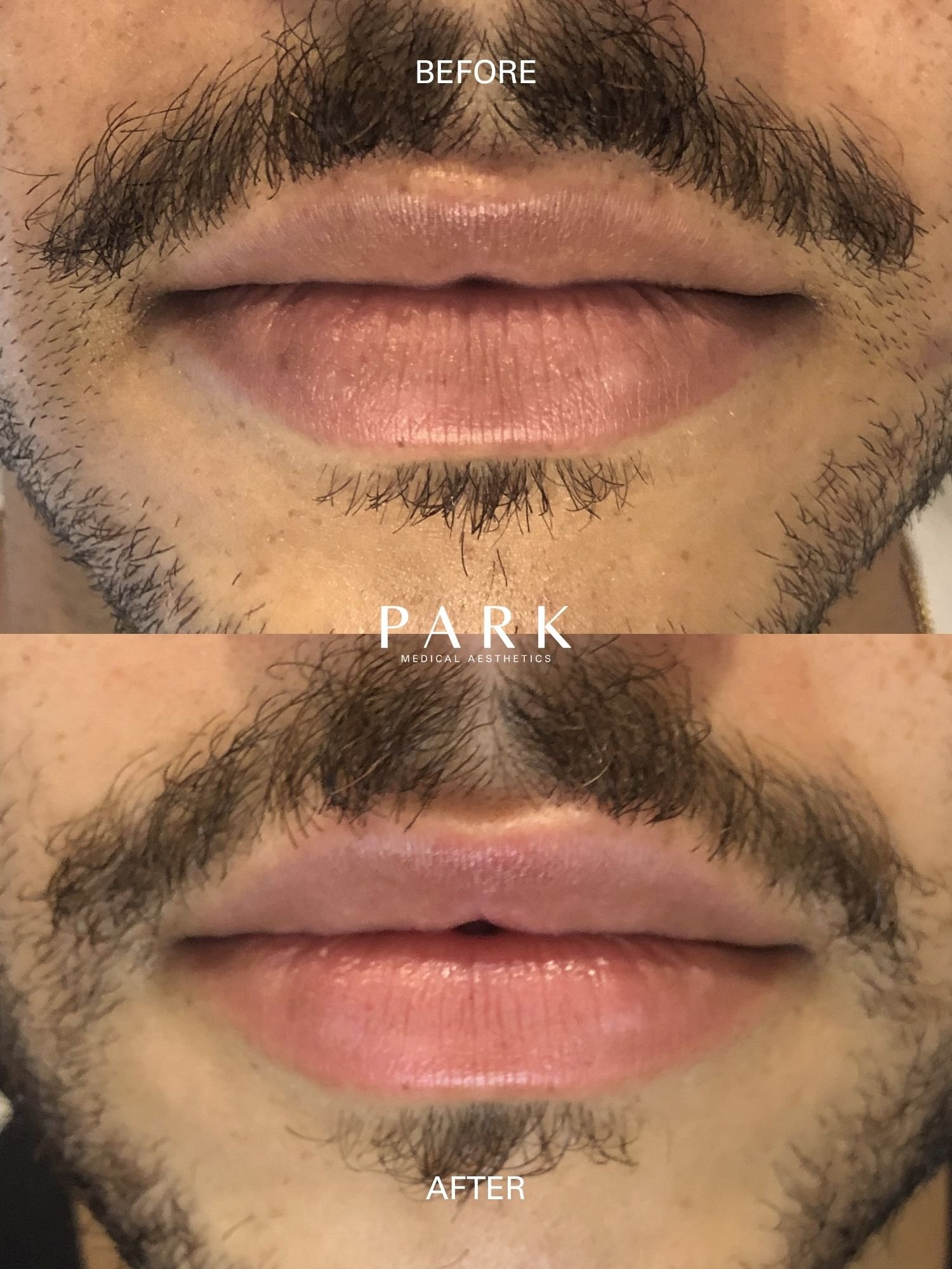 Before and after of lip filler on a male client at Park Medical Aesthetics.