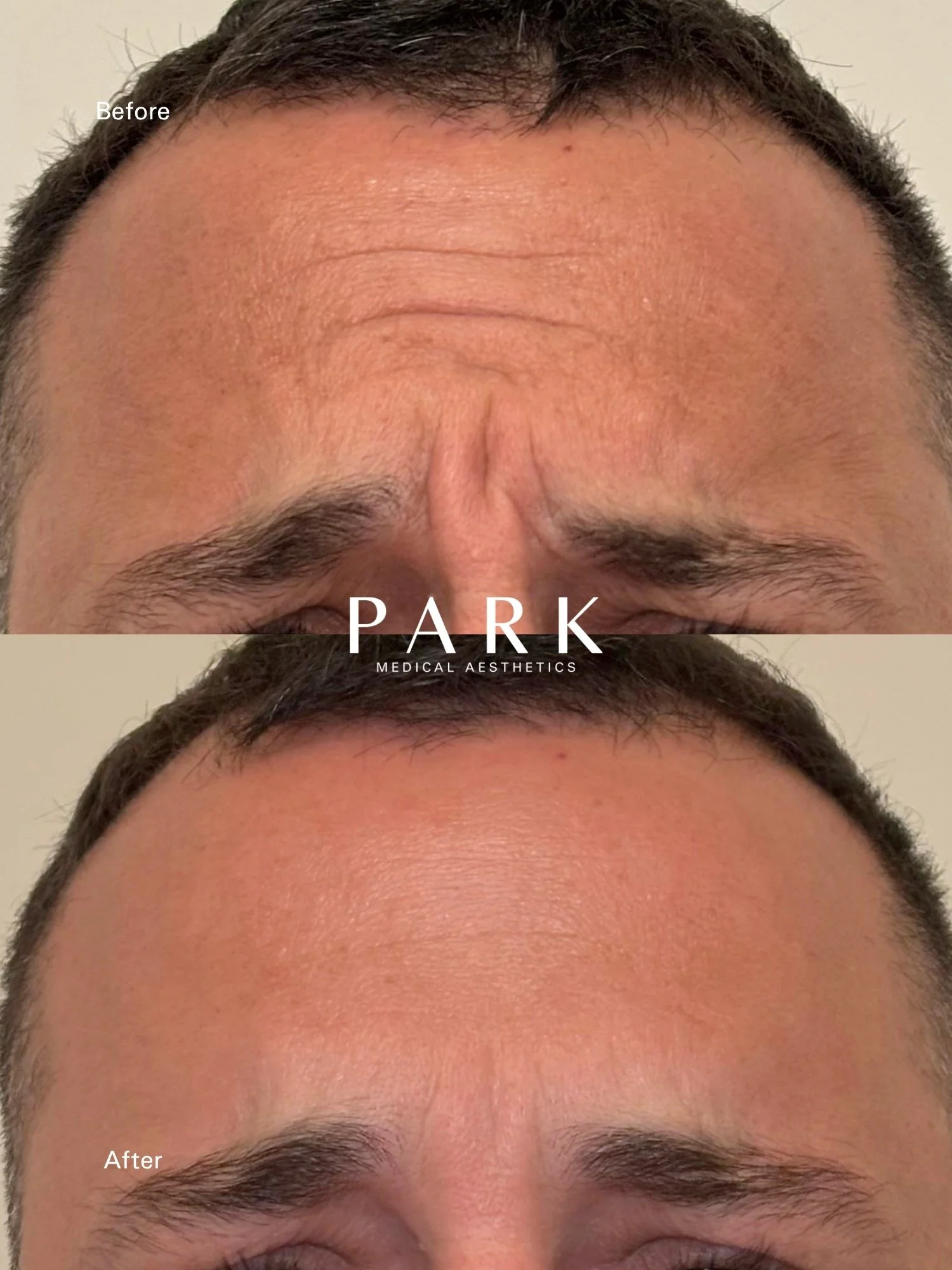 Male patient. Before and after of a typical neurotoxin treatment result in the glabella region.