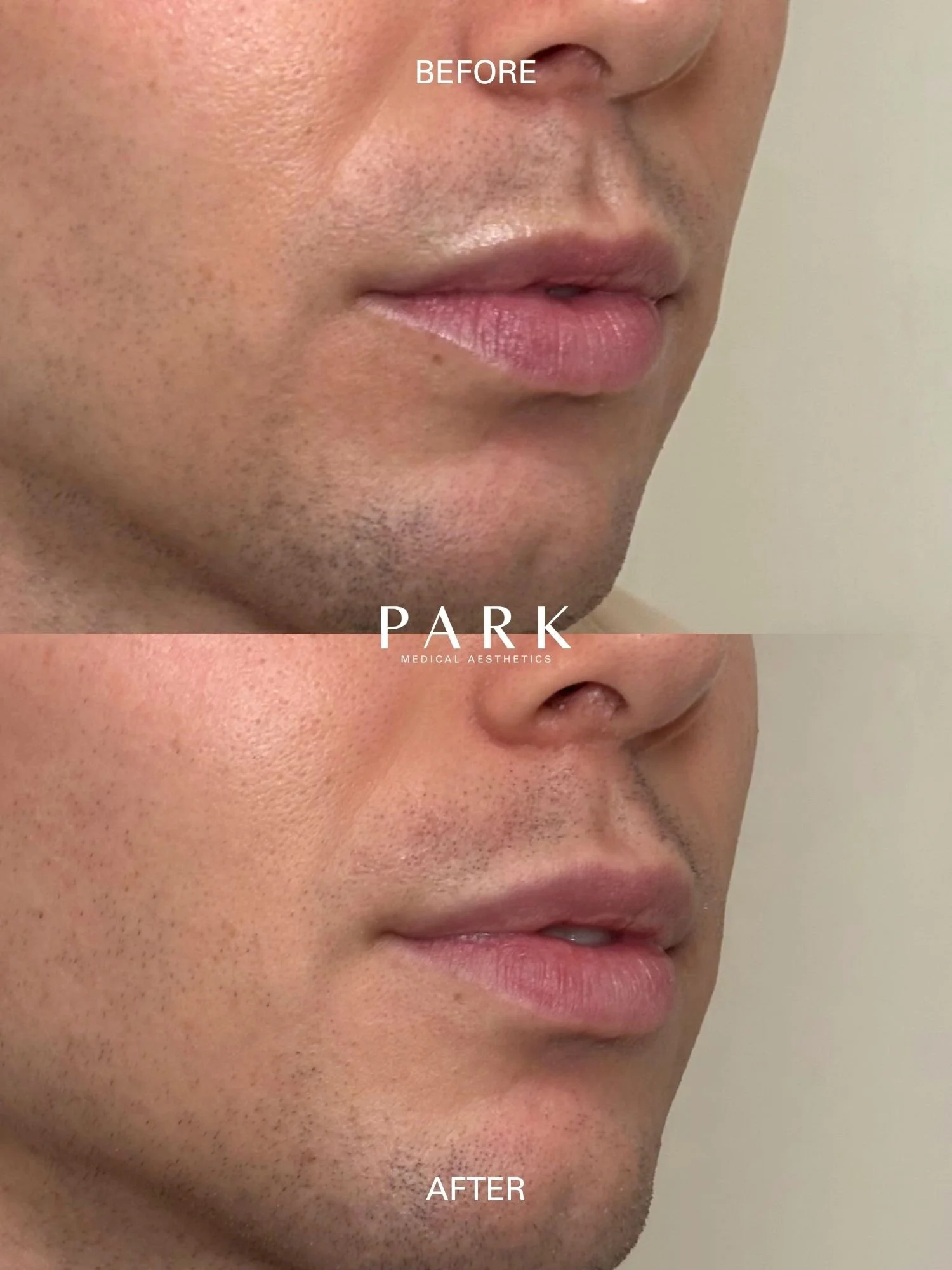 Before and after of lip filler on a male client at Park Medical Aesthetics.