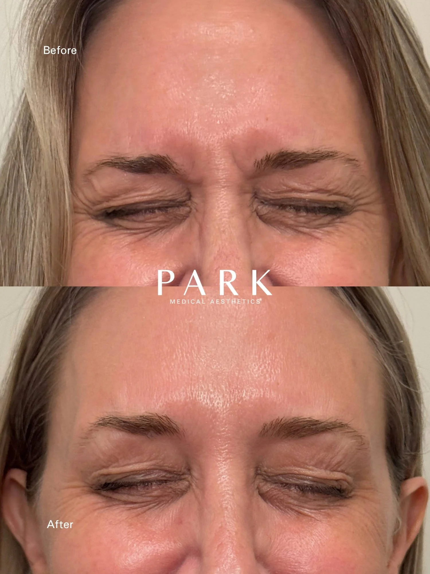 Female patient. Before and after of a typical neurotoxin treatment result in the glabella region.