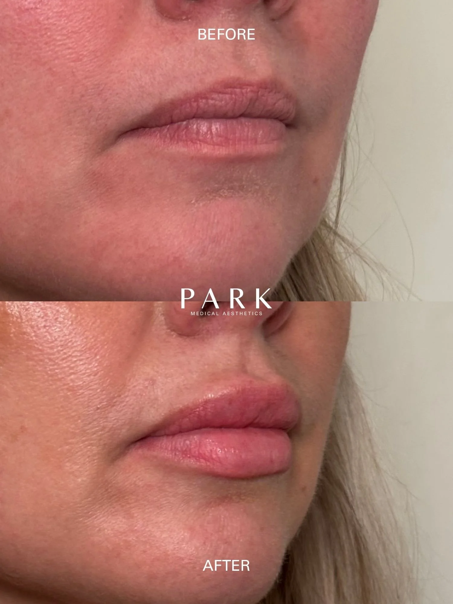 Before and after of lip filler on a female client at Park Medical Aesthetics.