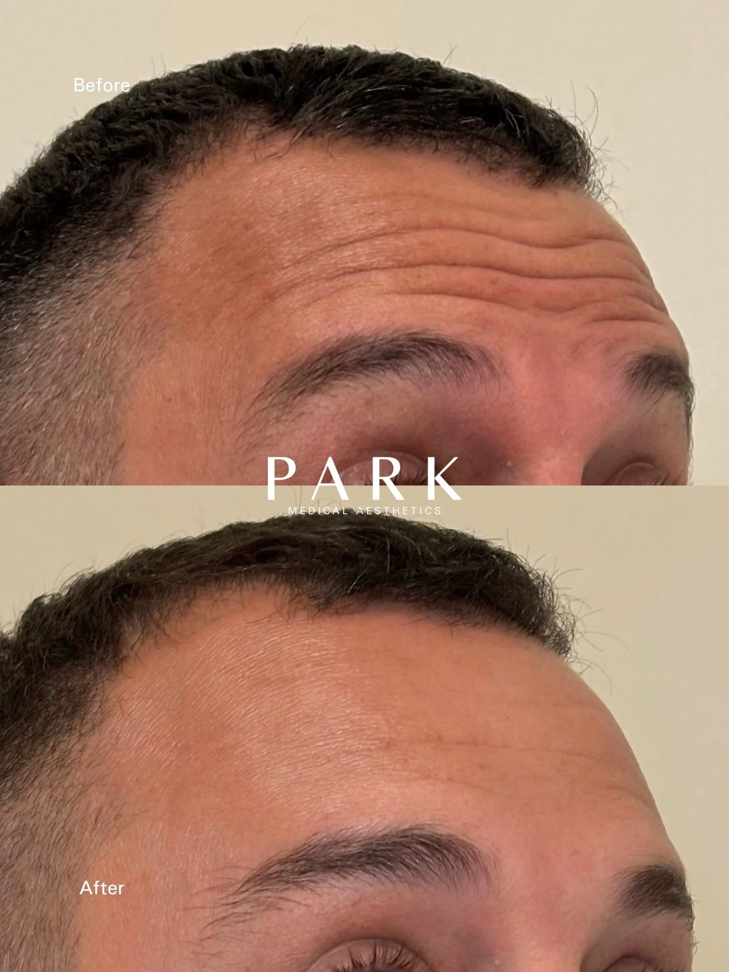 Male patient. Before and after of a typical neurotoxin treatment result in the forehead region.