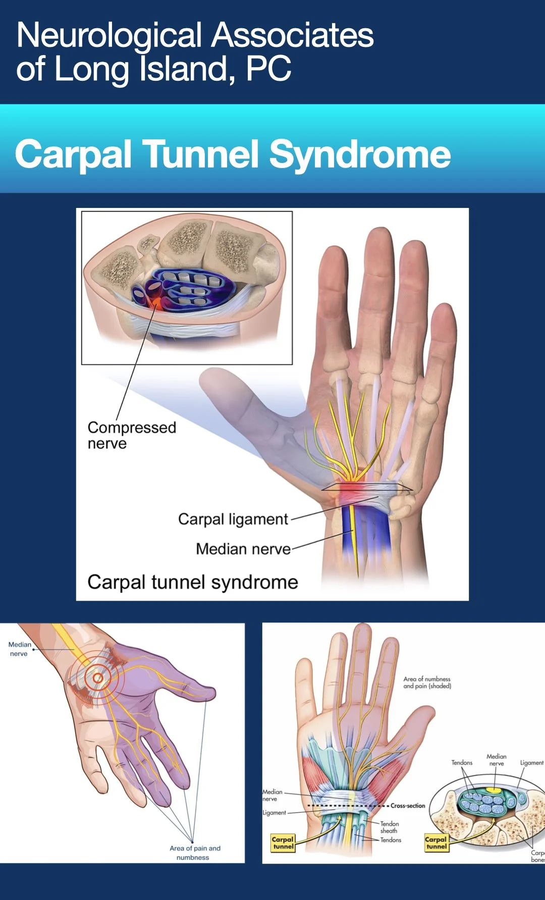 Carpal Tunnel Syndrome