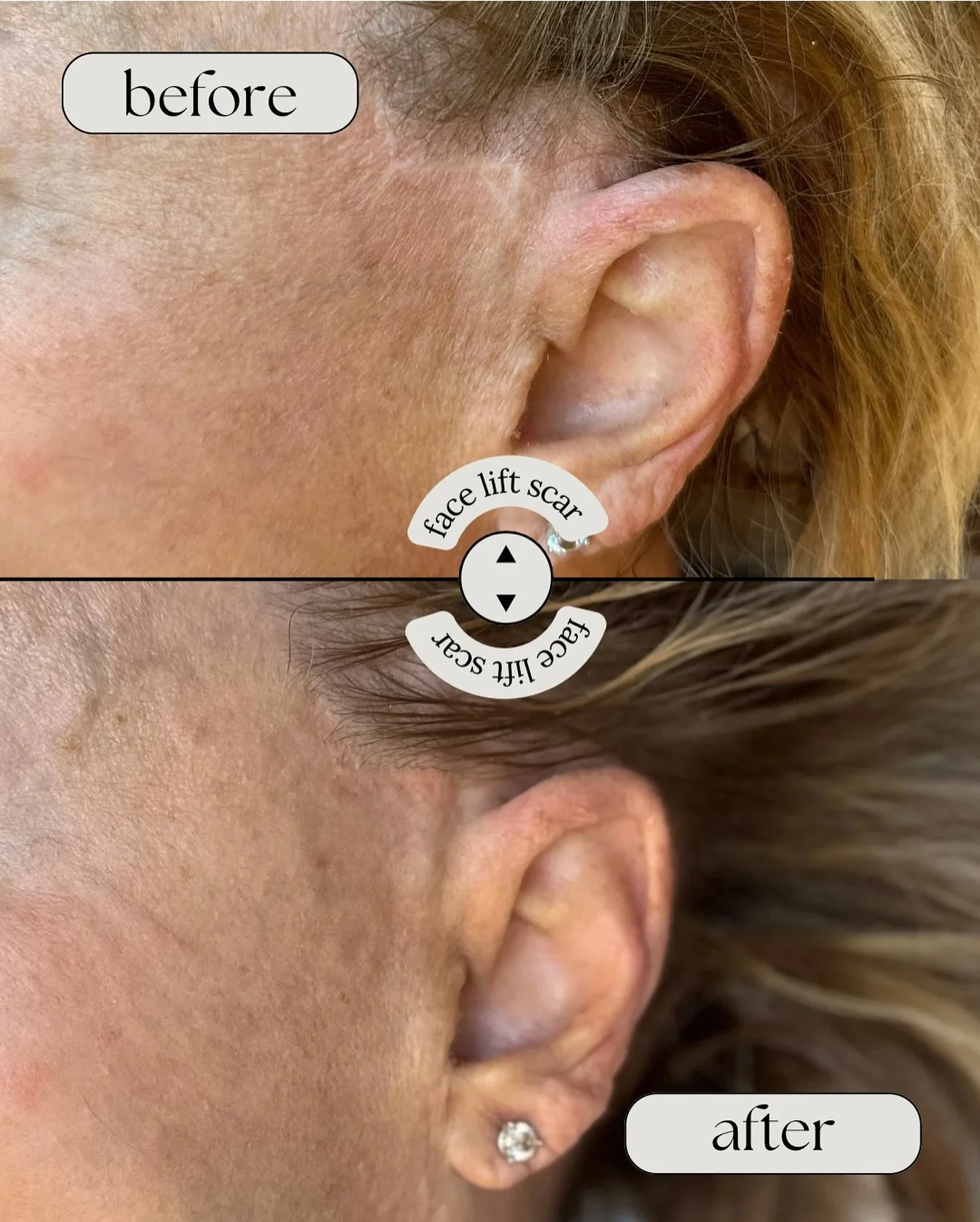 ✨ Scar Camouflage Tattoo ✨
This client wanted to soften a facelift scar near the ear &mdash; and this is the power of camouflage tattooing.

By carefully blending pigment into the skin, we create a more seamless, natural look that helps restore confi