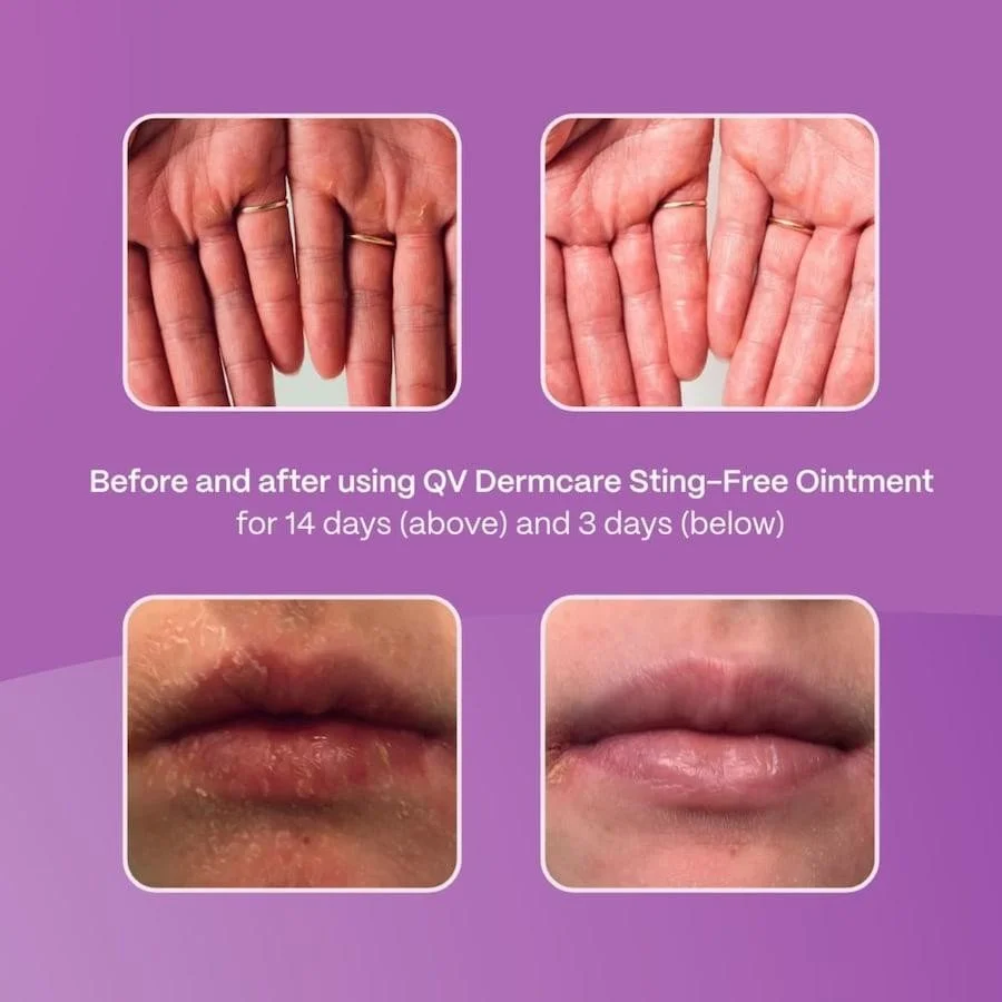 Supplementary retail asset - QV Dermcare Sting-Free Ointment  
 QV Skincare 