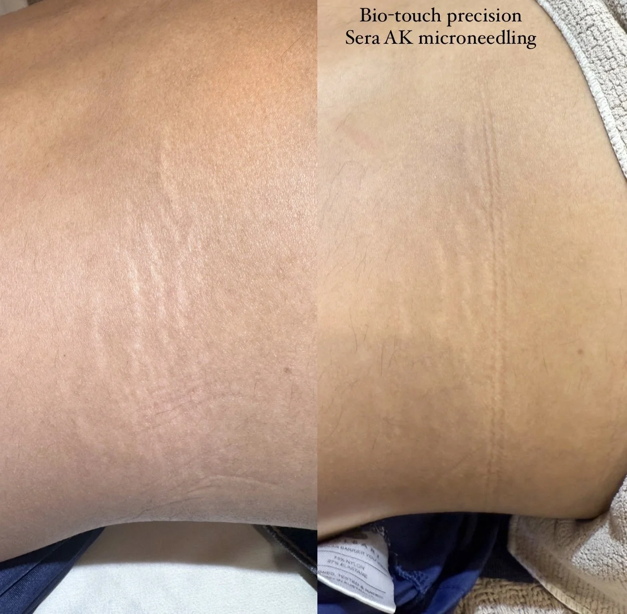 Bio touch Sera AK microneedling