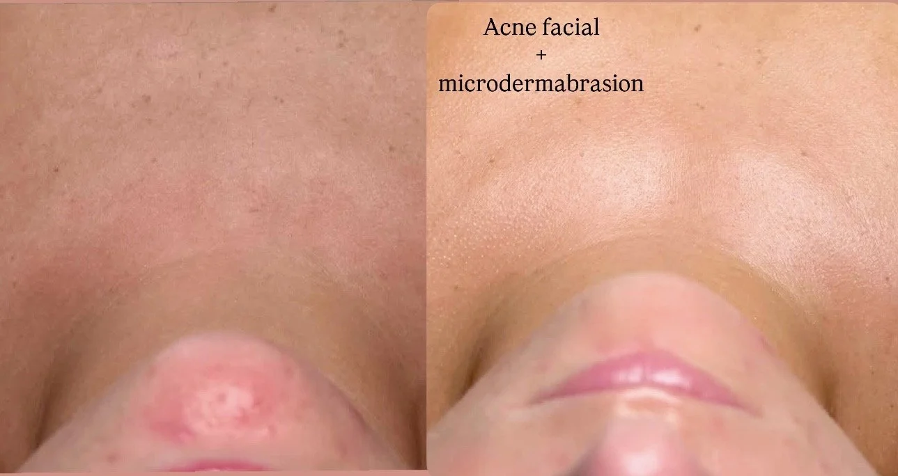 Microdermabrasion & Acne facial