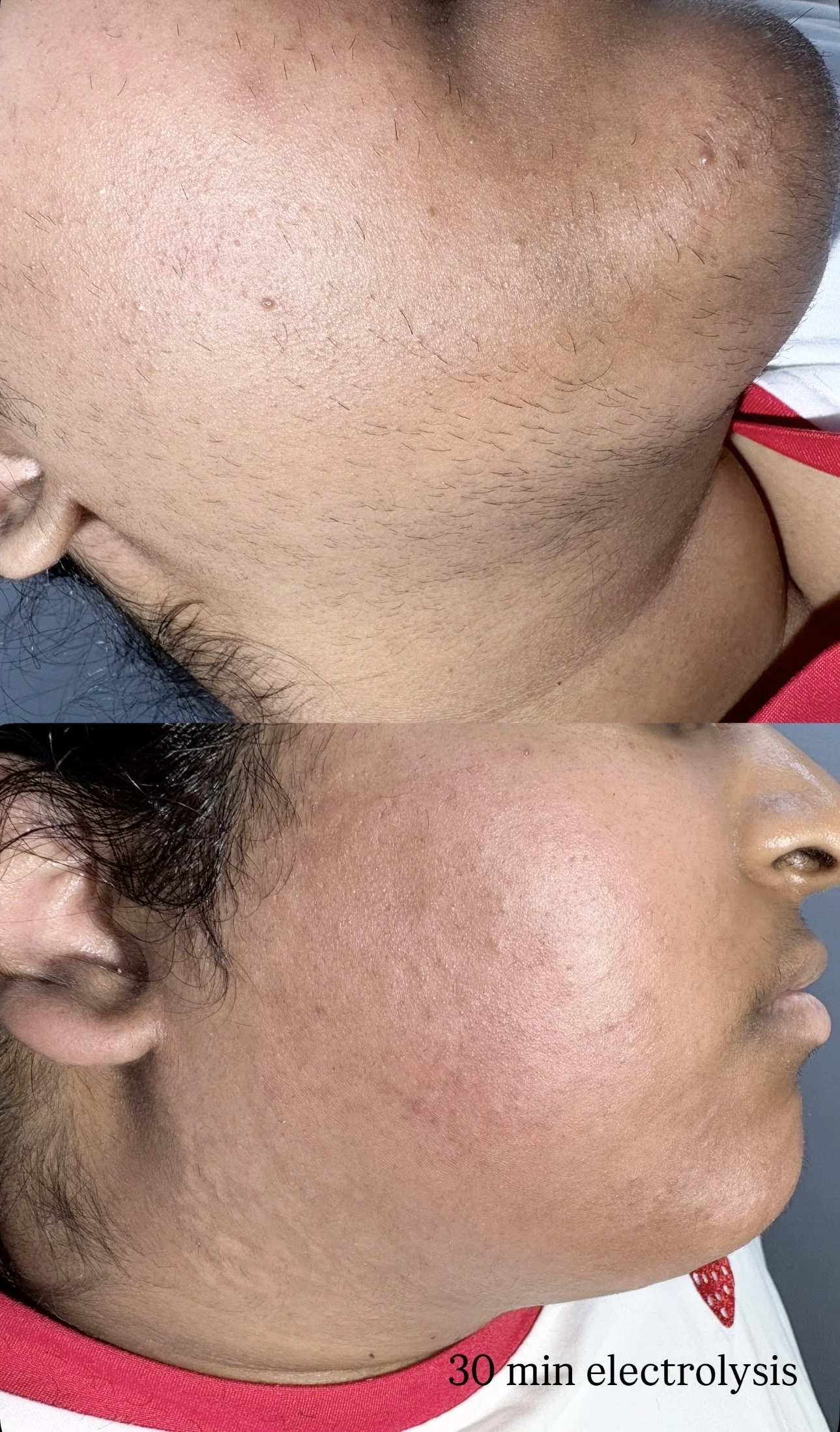 Electrolysis 30 min