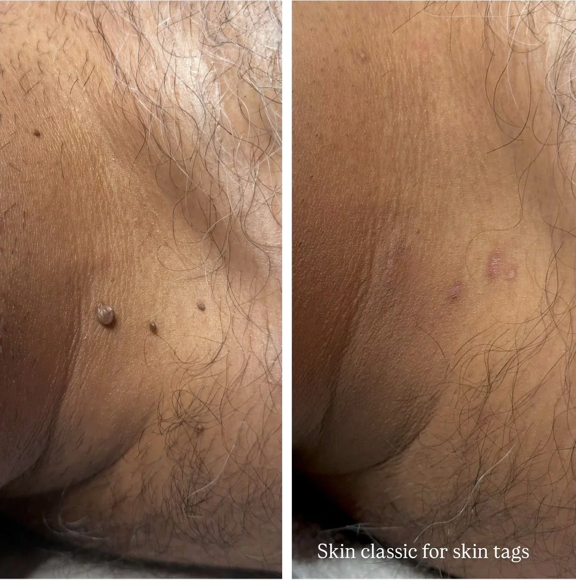 skin tags
