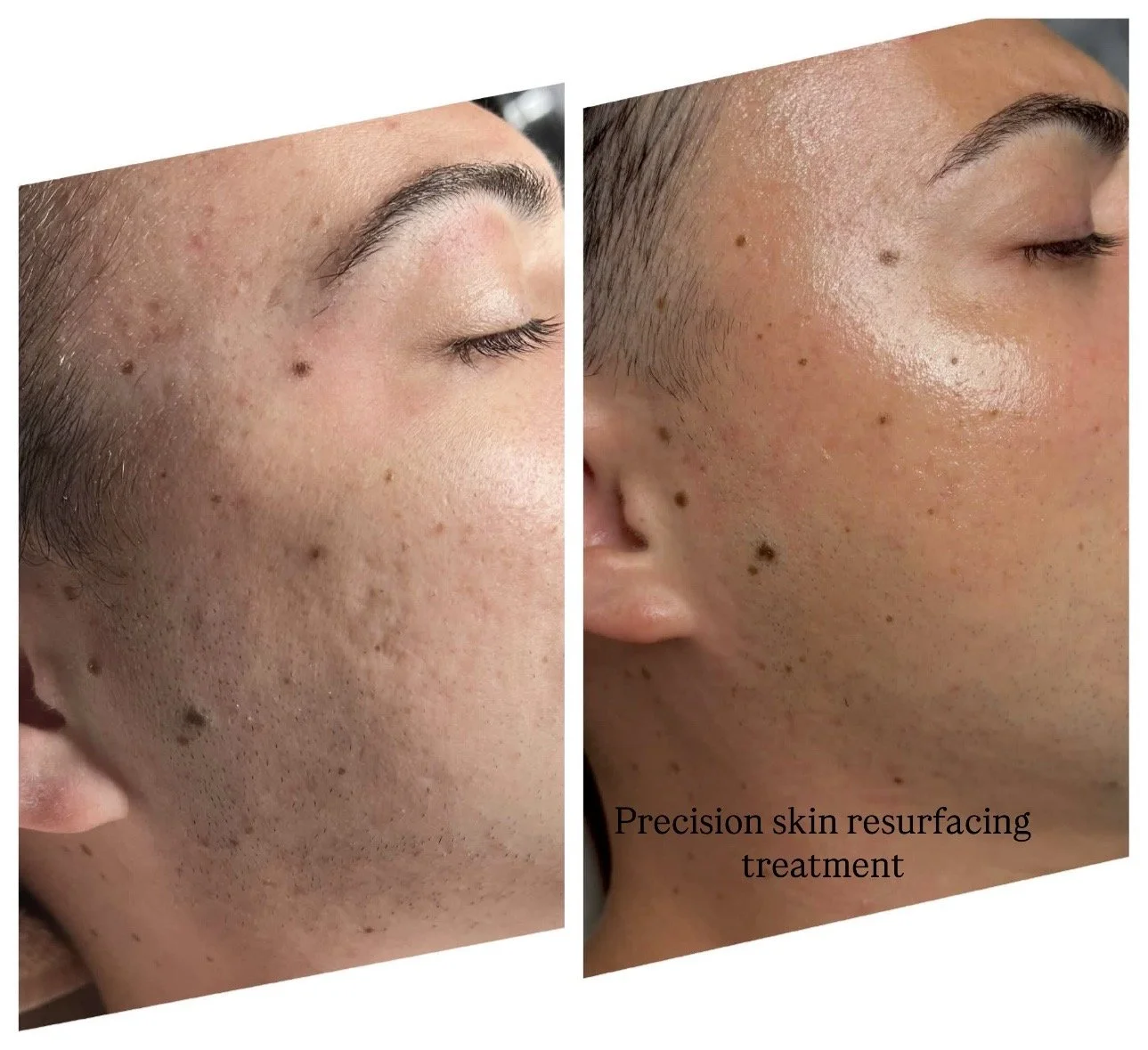 Precision Skin Resurfacing