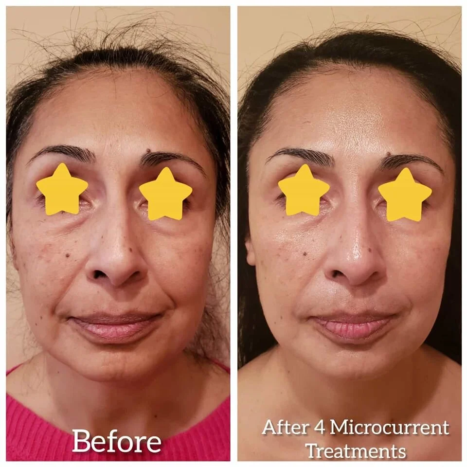 Before/After 4 Microcurrent Treatments