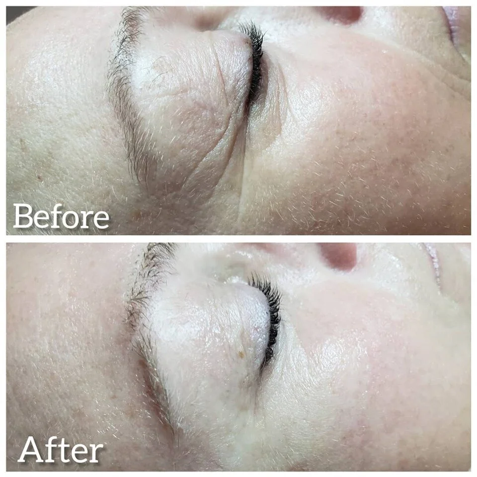 Before/After 1 Microcurrent Treatment