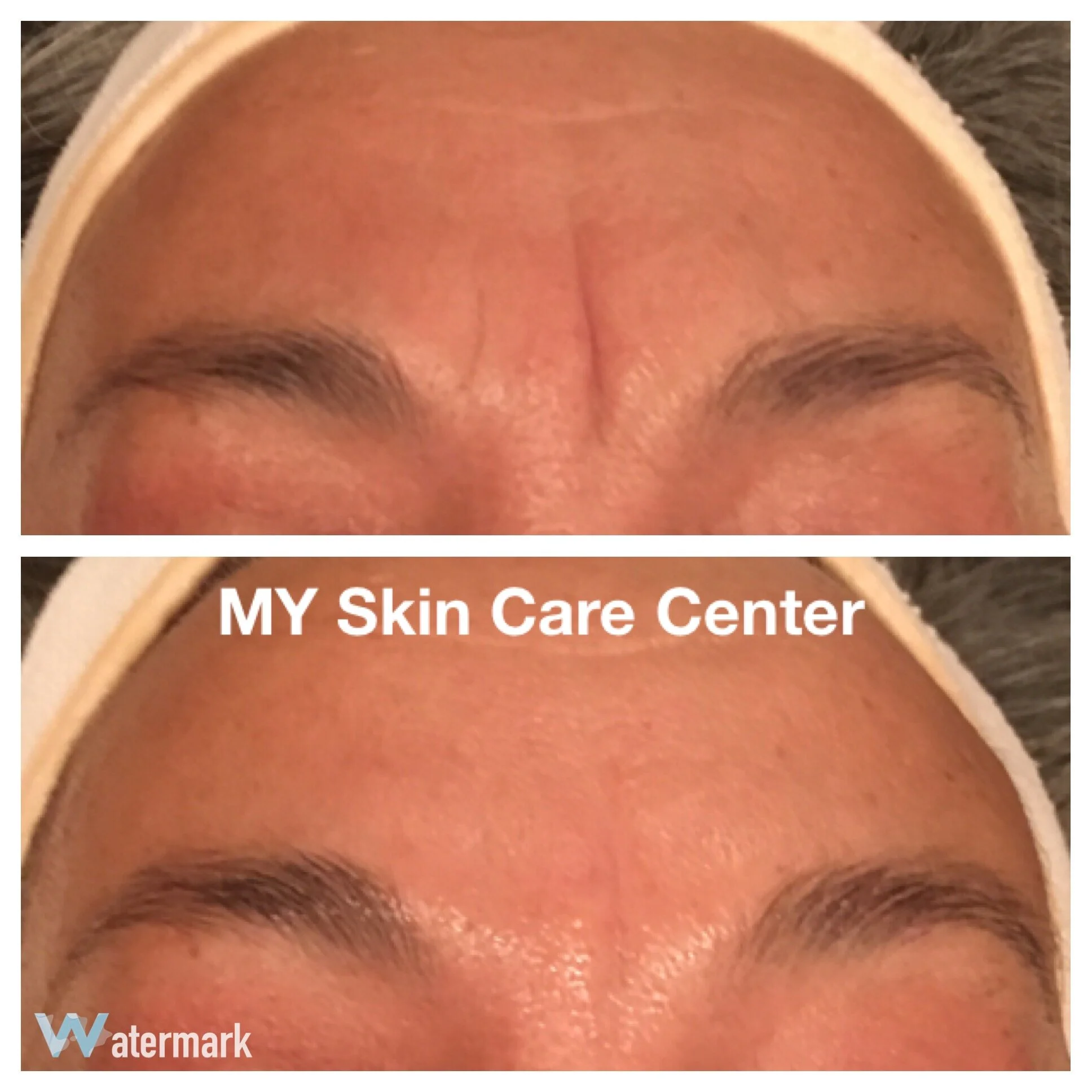 Before/After 1 Microcurrent Treatment
