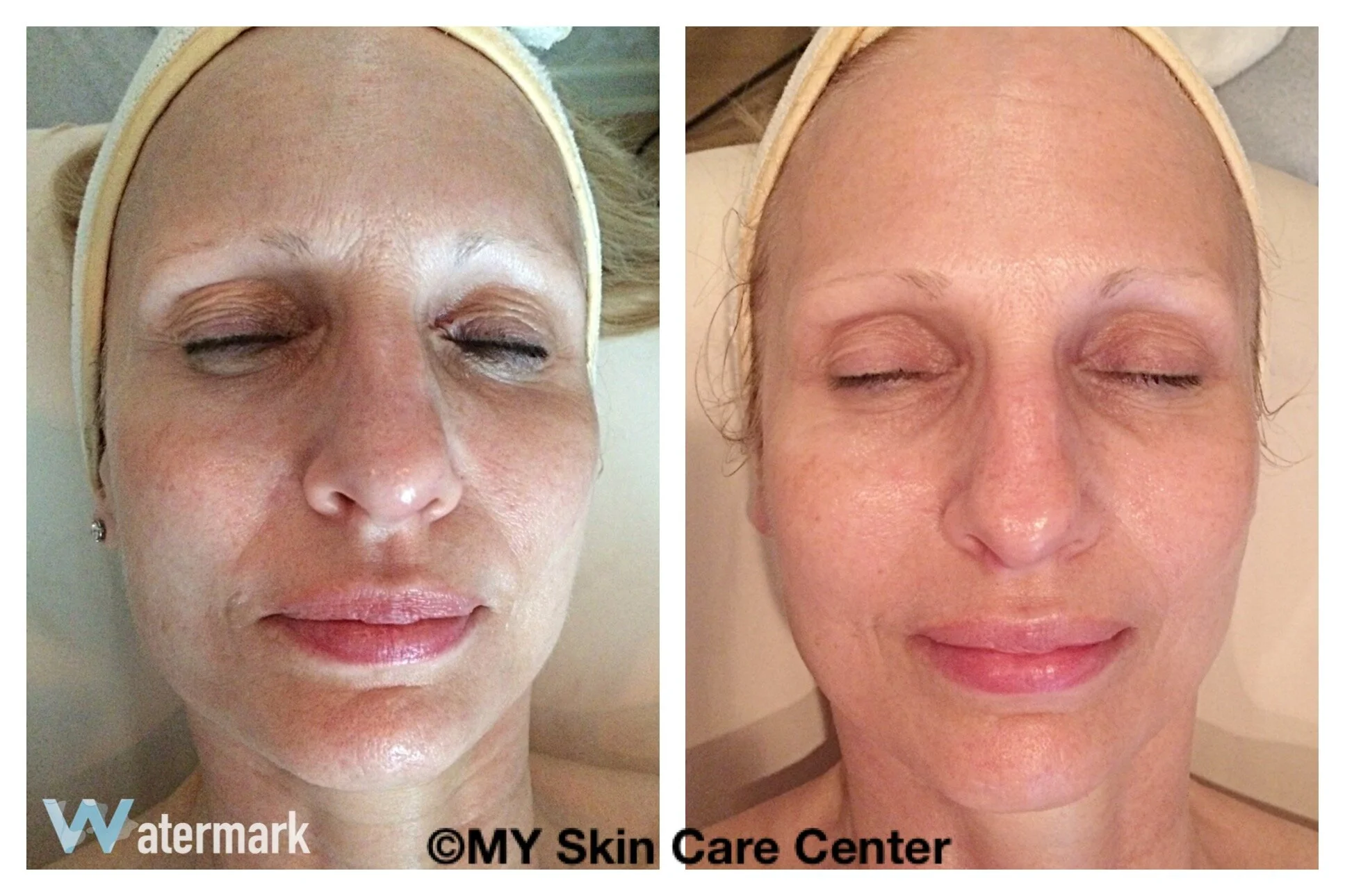 Before/After 4 Microcurrent Treatments