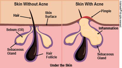 WHAT IS ACNE?
