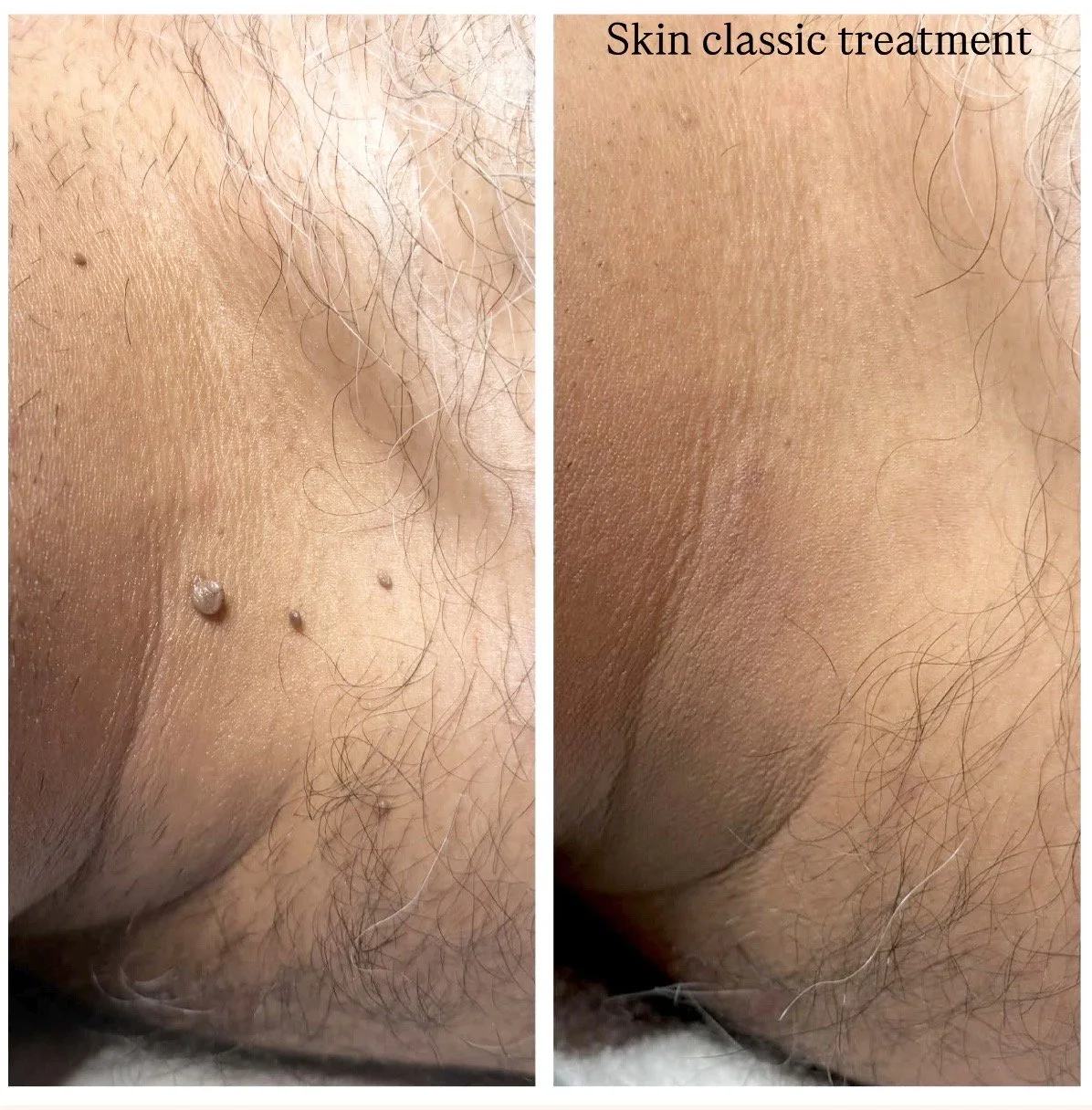Skin classic treatment