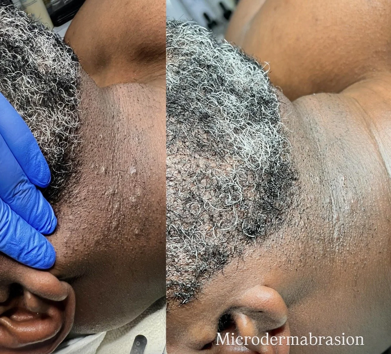 Microdermabrasion
