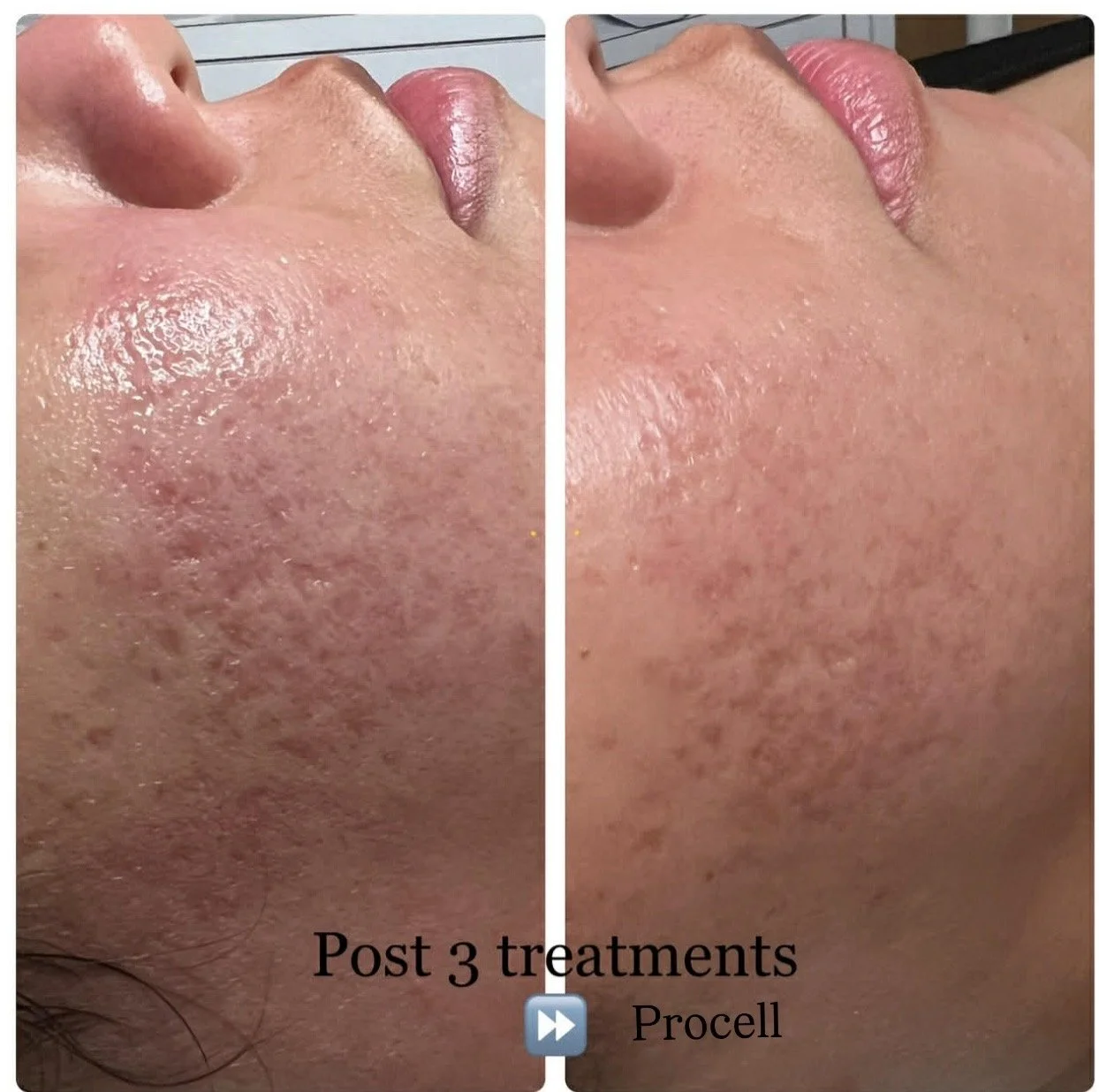 Procell after 3 treatments