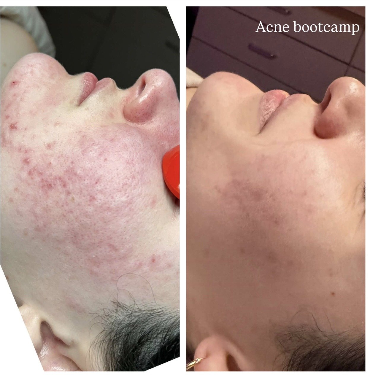 acne bootcamp