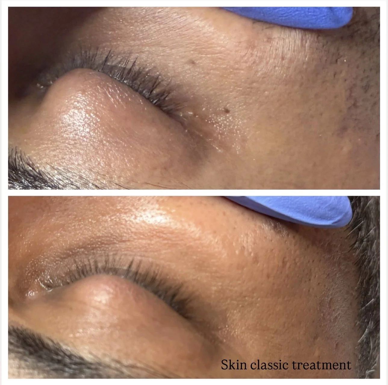 Skin classic treatment