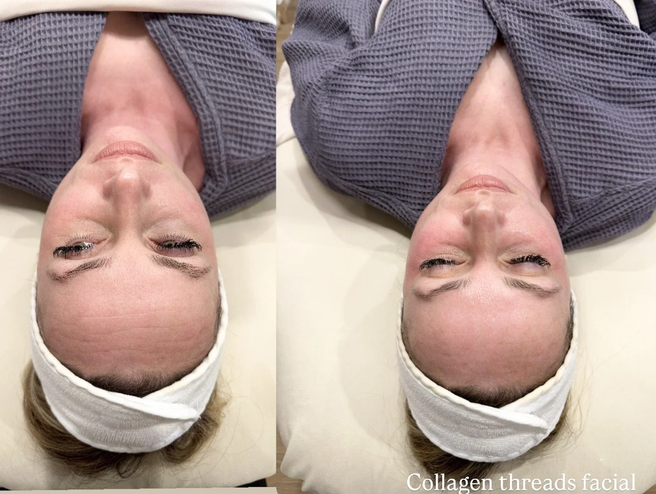 collagen threads facial 