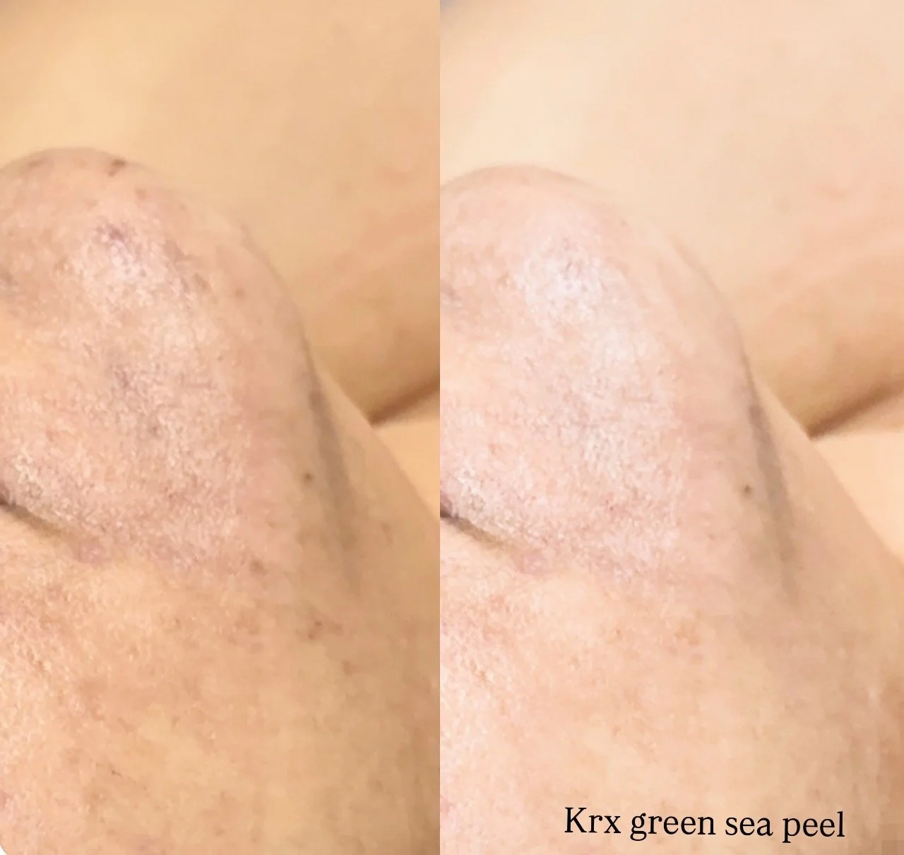 KRX green sea peel