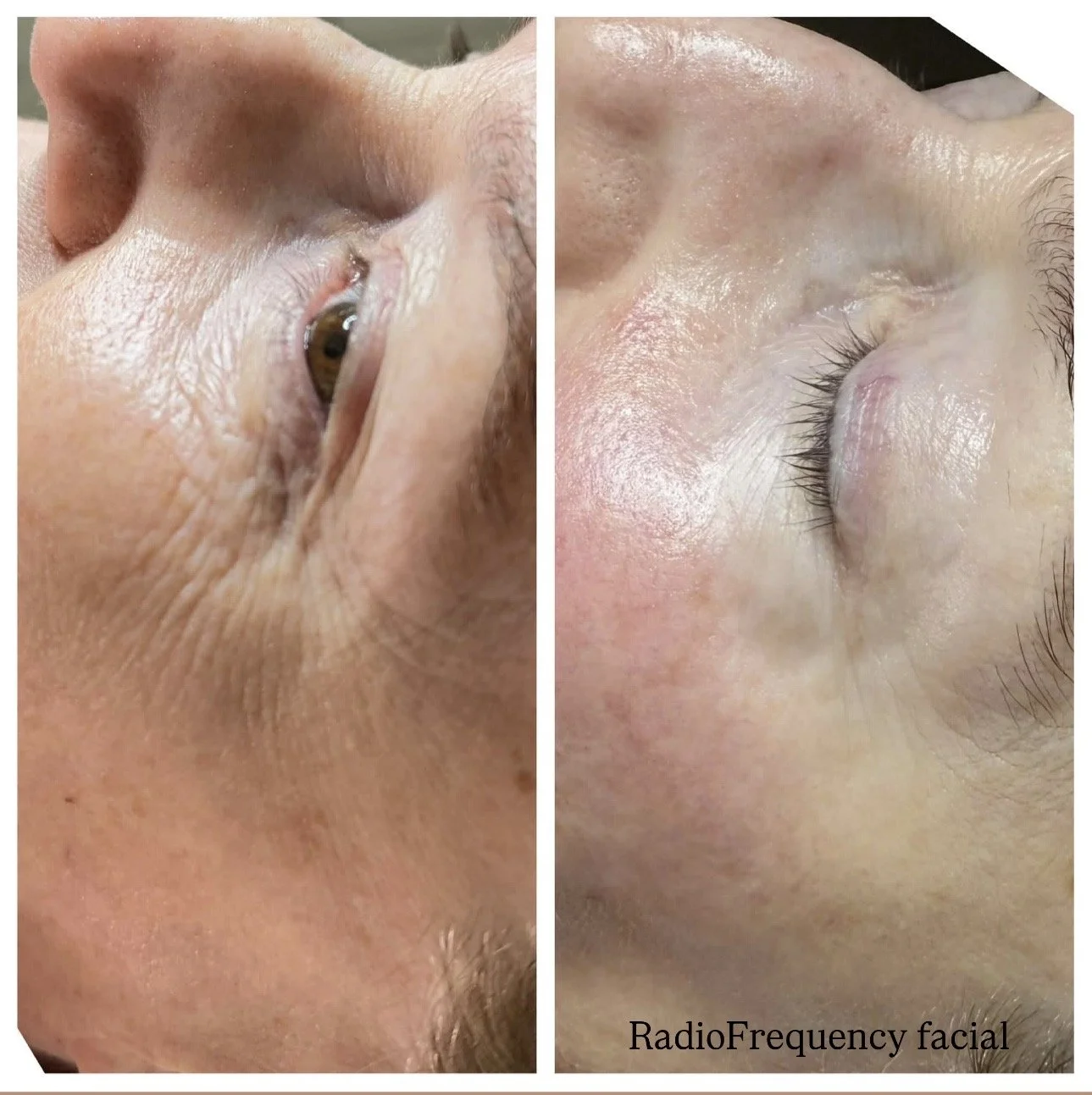 Radiofrequency treatment