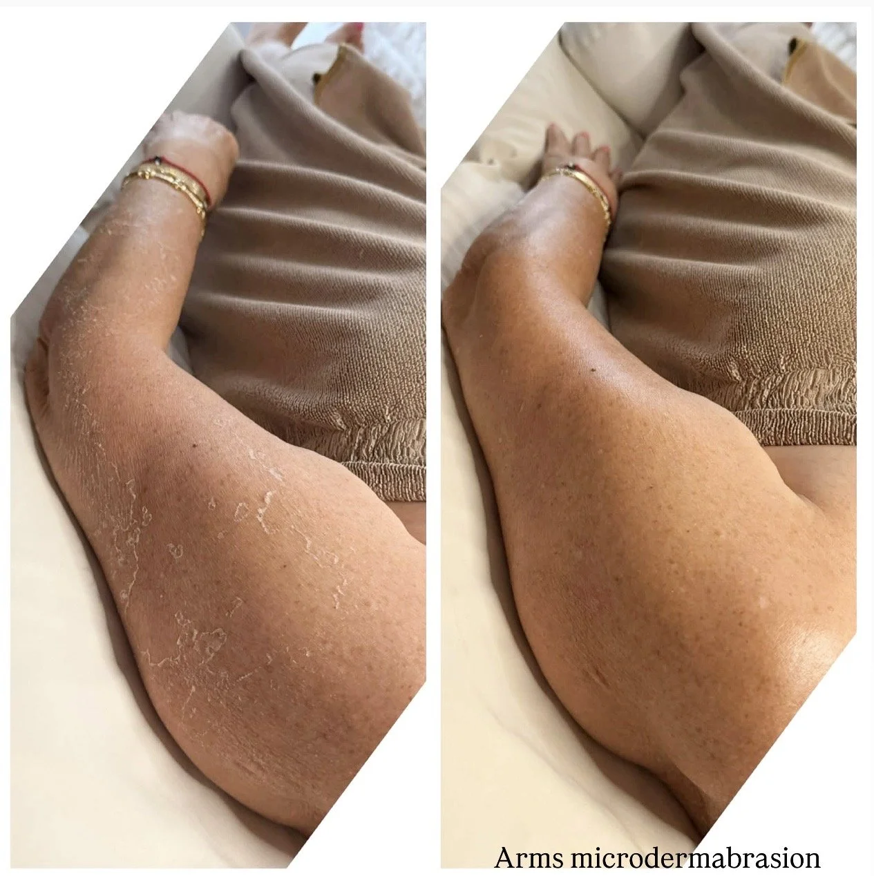 Microdermabrasion