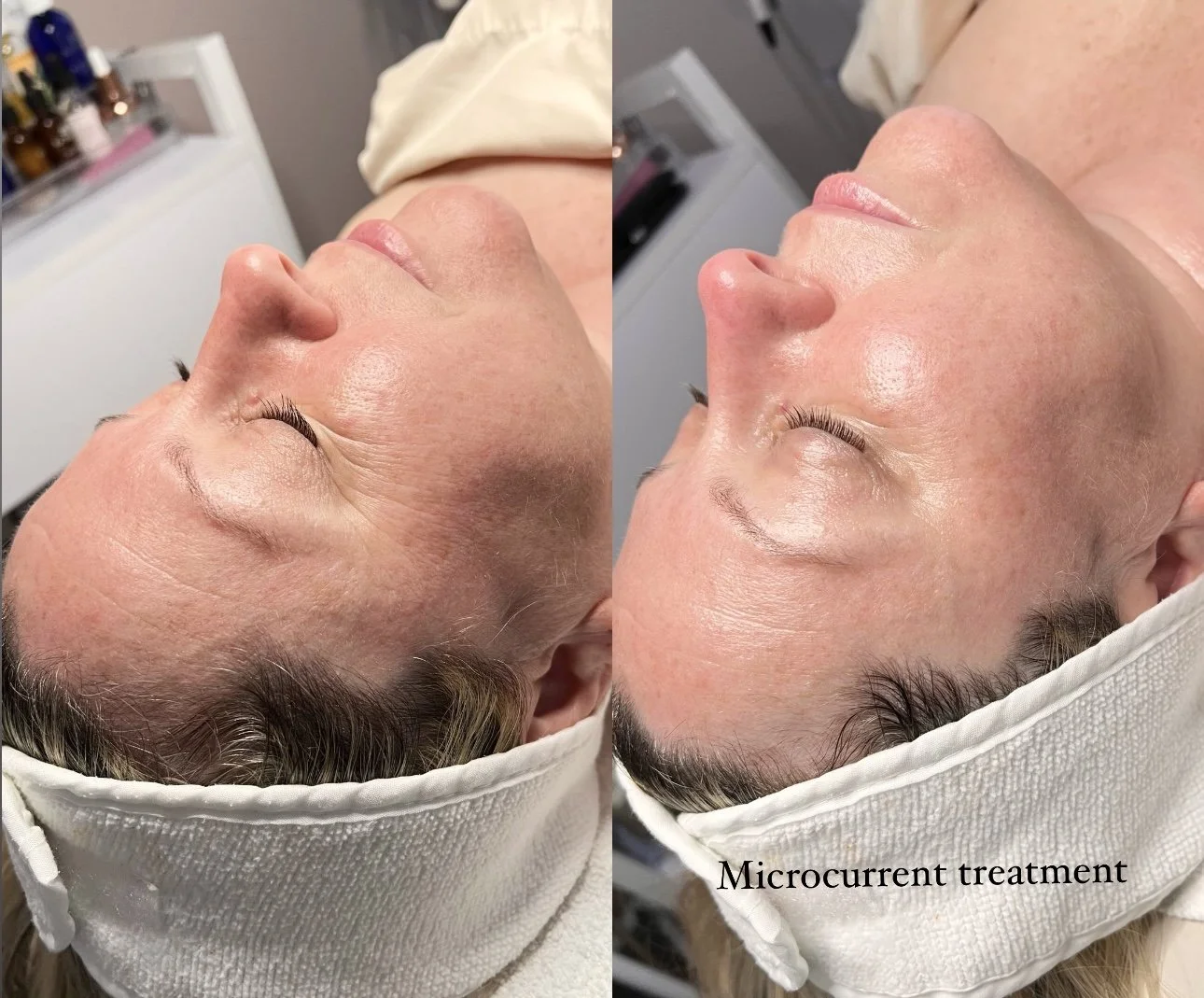 microcurrent after 1 treatment