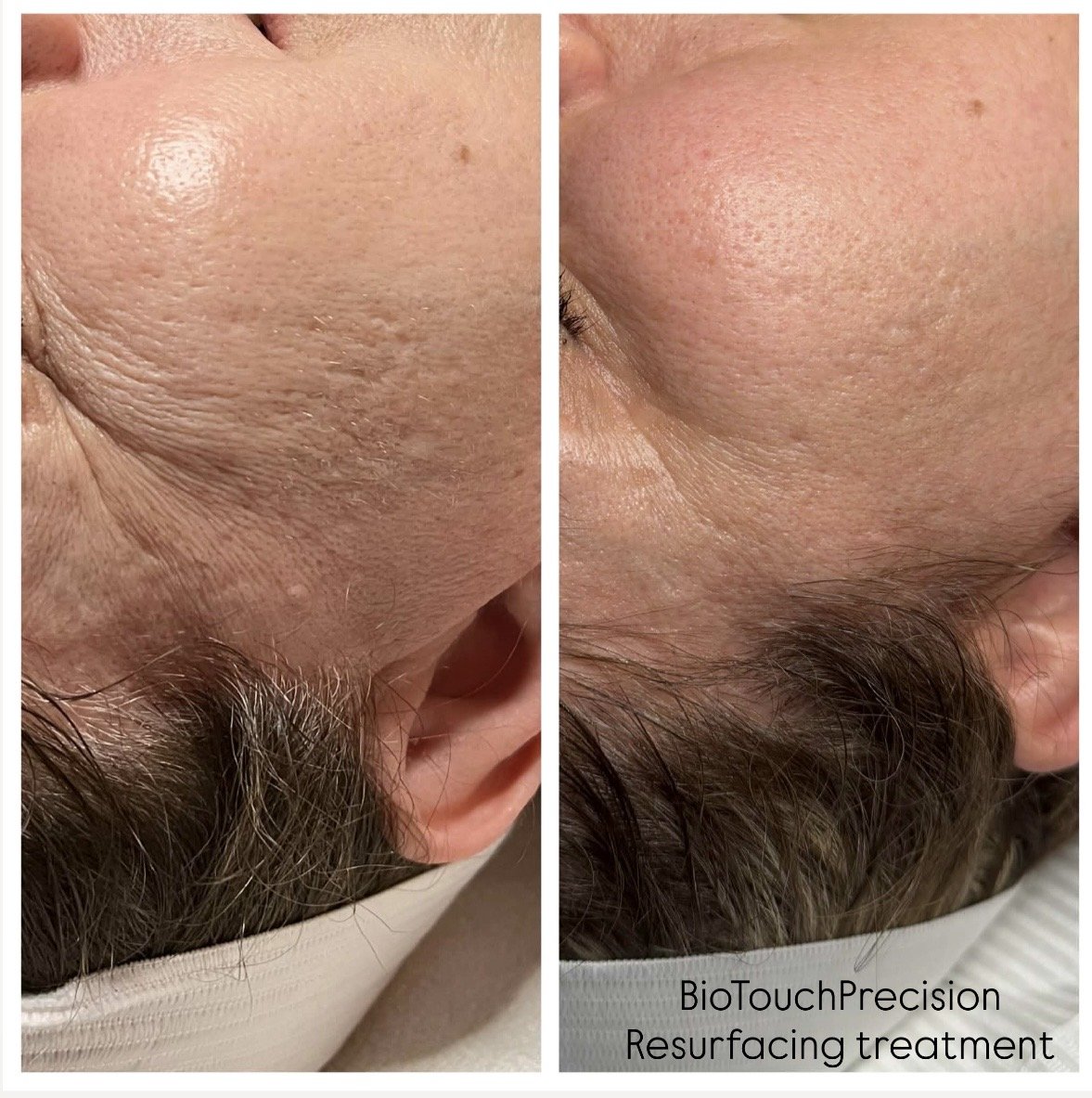 Precision Skin Resurfacing