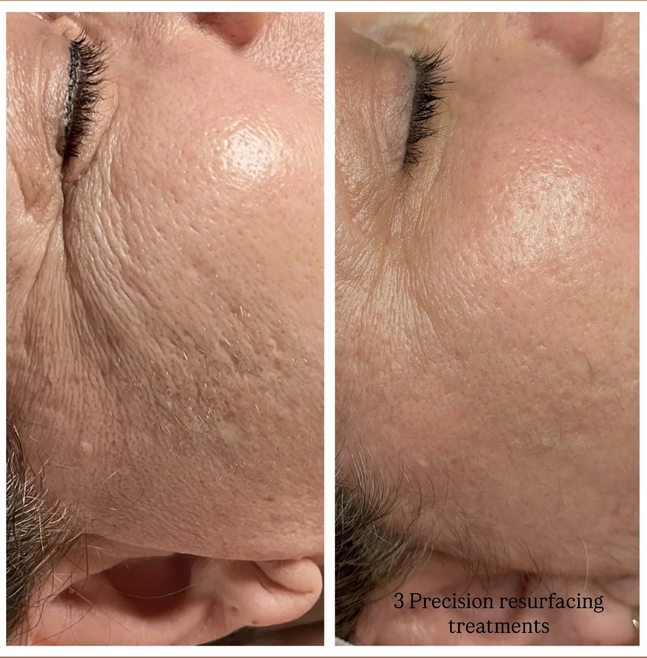 Precision Skin Resurfacing