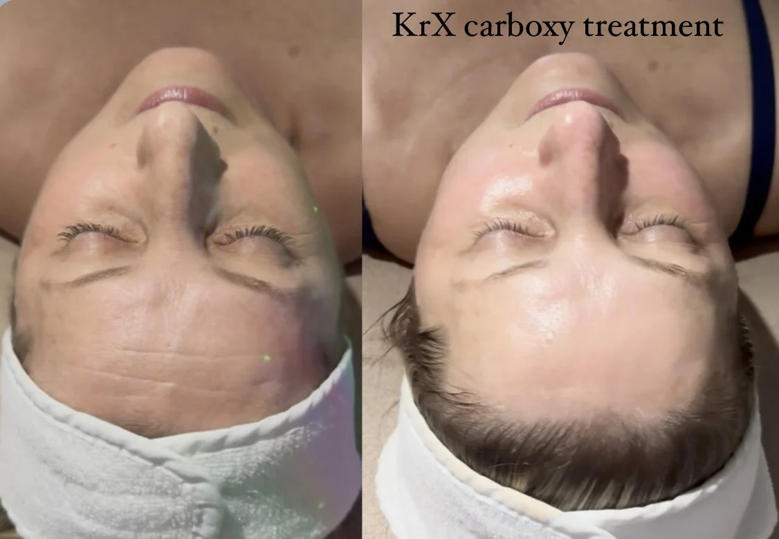 KrX carboxy treatment
